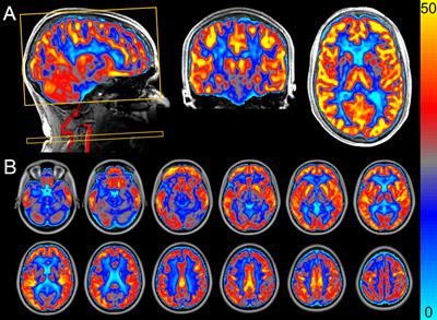 Aerobic Exercise Training Improves Cerebral Blood Flow and Executive Function: A Randomized, Controlled Cross-Over Trial in Sedentary Older Men